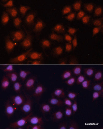 Immunohistochemistry of paraffin-embedded Human liver cancer using ECI2 Polyclonal Antibody at dilution of 1:150 (40x lens).