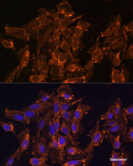 Immunohistochemistry of paraffin-embedded Human lung cancer using OTP Polyclonal Antibody at dilution of 1:100 (40x lens).