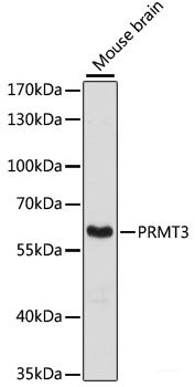 Immunohistochemistry of paraffin-embedded Human oophoroma using CD68 Polyclonal Antibody at dilution of 1:100 (40x lens).