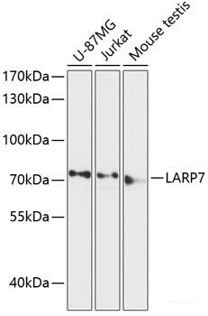 Immunohistochemistry of paraffin-embedded Human liver cancer using HADHA Polyclonal Antibody at dilution of 1:100 (40x lens).