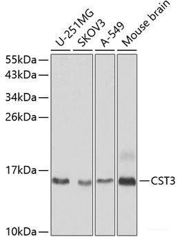 Immunohistochemistry of paraffin-embedded Human liver cancer using ACCS Polyclonal Antibody at dilution of 1:200 (40x lens).
