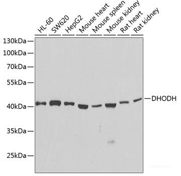 Immunohistochemistry of paraffin-embedded Human liver cancer using MLKL Polyclonal Antibody at dilution of 1:100 (40x lens).