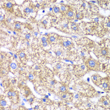 Immunohistochemistry of paraffin-embedded Human colon carcinoma using TET3 Polyclonal Antibody at dilution of 1:200 (40x lens).