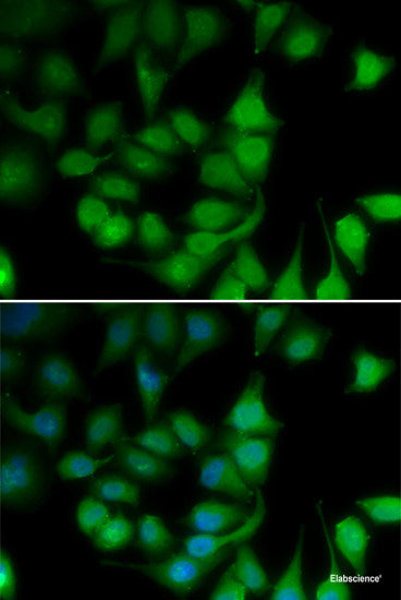 Immunohistochemistry of paraffin-embedded Human liver cancer using CYP3A4 Polyclonal Antibody at dilution of 1:100 (40x lens).