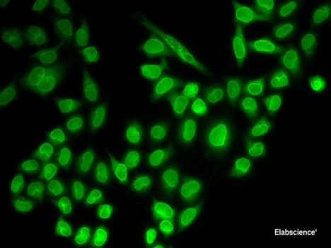 Immunohistochemistry of paraffin-embedded Human lung cancer using FGFR1 Polyclonal Antibody at dilution of 1:100 (40x lens).