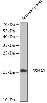 Immunohistochemistry of paraffin-embedded Human lung cancer using MCM5 Polyclonal Antibody at dilution of 1:100 (40x lens).