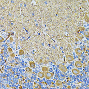 Immunohistochemistry of paraffin-embedded Human esophageal cancer using PPP1CB Polyclonal Antibody at dilution of 1:100 (40x lens).
