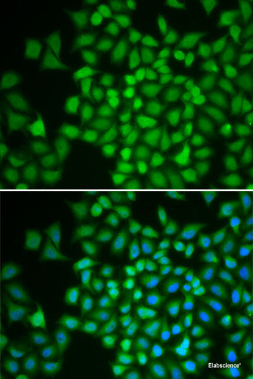 Immunohistochemistry of paraffin-embedded Human liver cancer using UPF1 Polyclonal Antibody at dilution of 1:100 (40x lens).