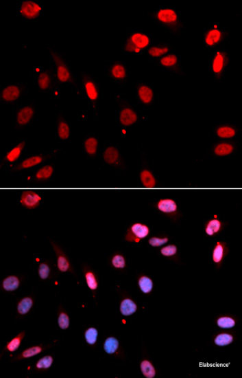 Immunohistochemistry of paraffin-embedded Human liver cancer using TIMM17A Polyclonal Antibody at dilution of 1:100 (40x lens).