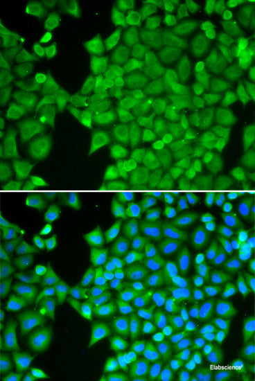 Immunohistochemistry of paraffin-embedded Human liver cancer using KLK10 Polyclonal Antibody at dilution of 1:100 (40x lens).