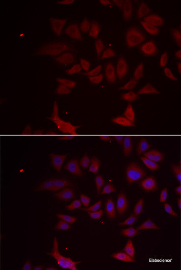 Immunohistochemistry of paraffin-embedded Human lung cancer using ZNF707 Polyclonal Antibody at dilution of 1:100 (40x lens).