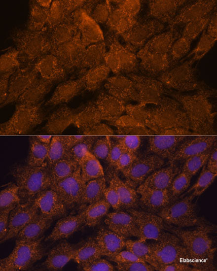 Immunohistochemistry of paraffin-embedded Human lung cancer using ATP1B1 Polyclonal Antibody at dilution of 1:100 (40x lens).