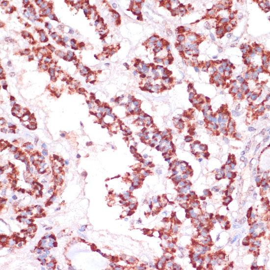 Immunohistochemistry of paraffin-embedded Human mammary cancer using SLC7A2 Polyclonal Antibody at dilution of 1:100 (40x lens).