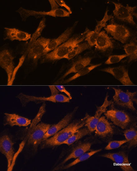 Immunohistochemistry of paraffin-embedded Human uterine cancer using IFT57 Polyclonal Antibody at dilution of 1:100 (40x lens).