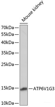 Immunohistochemistry of paraffin-embedded Human gastric cancer using CDH11 Polyclonal Antibody at dilution of 1:100 (40x lens).