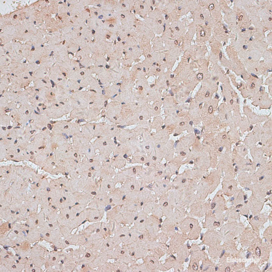 Immunofluorescence analysis of Human kidney cancer using SCNN1G Polyclonal Antibody at dilution of 1:100. Blue: DAPI for nuclear staining.
