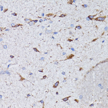 Immunohistochemistry of paraffin-embedded Human lung cancer using CD47 Polyclonal Antibody at dilution of 1:200 (40x lens).