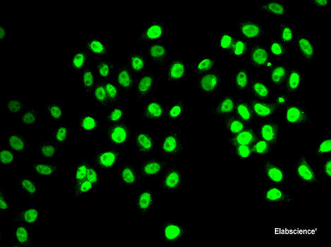 Immunohistochemistry of paraffin-embedded Human thyroid cancer using CFLAR Polyclonal Antibody at dilution of 1:100 (40x lens).