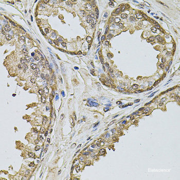 Immunohistochemistry of paraffin-embedded Human lung cancer using NELFE Polyclonal Antibody at dilution of 1:100 (40x lens).