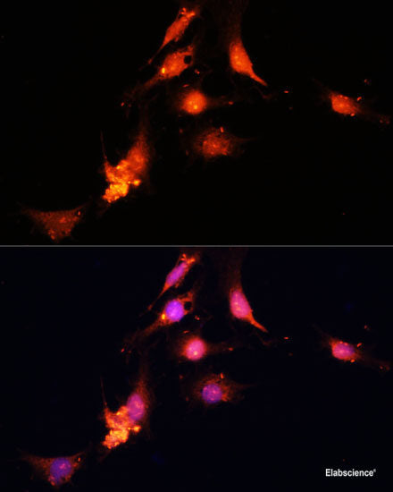 Immunohistochemistry of paraffin-embedded Human esophageal cancer using PARN Polyclonal Antibody at dilution of 1:100 (40x lens).