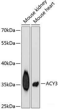 Immunohistochemistry of paraffin-embedded Human liver cancer using RIP3 Polyclonal Antibody at dilution of 1:100 (40x lens).