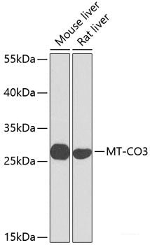 Immunohistochemistry of paraffin-embedded Human breast carcinoma using Phospho-ABL1(Y412) Polyclonal Antibody