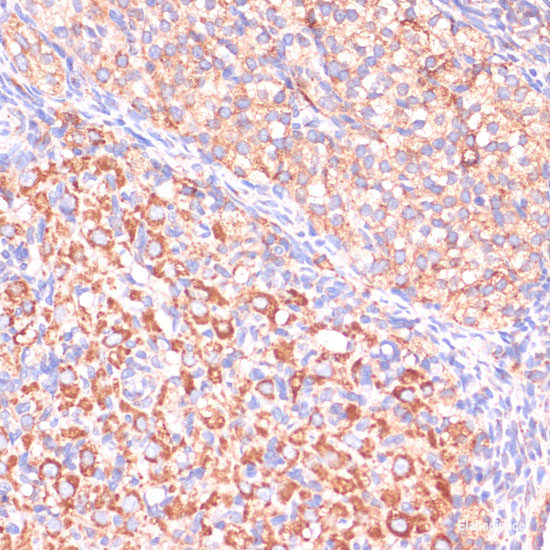 Immunohistochemistry of paraffin-embedded Human liver cancer using YAP1 Polyclonal Antibody at dilution of 1:100 (40x lens).