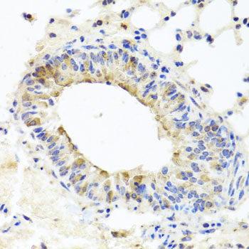 Immunohistochemistry of paraffin-embedded Human lung cancer using MMP16 Polyclonal Antibody at dilution of 1:100 (40x lens).