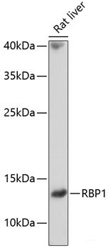 Immunohistochemistry of paraffin-embedded Human breast cancer using CTSF Polyclonal Antibody at dilution of 1:100 (40x lens).