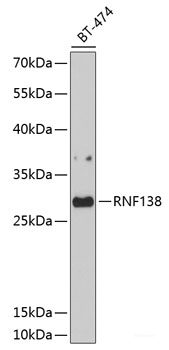 Immunofluorescence analysis of Human liver cancer using AFP Polyclonal Antibody at dilution of 1:100. Blue: DAPI for nuclear staining.