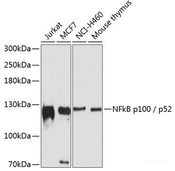 Immunohistochemistry of paraffin-embedded Human mammary cancer using ACSL3 Polyclonal Antibody at dilution of 1:100 (40x lens).