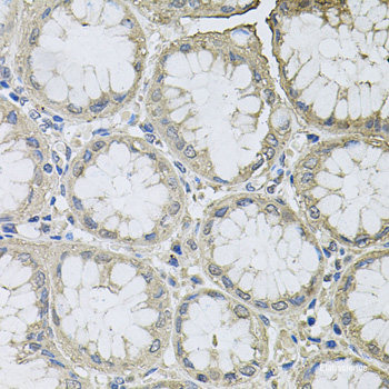 Immunohistochemistry of paraffin-embedded Human lung cancer using KL Polyclonal Antibody at dilution of 1:200 (40x lens).