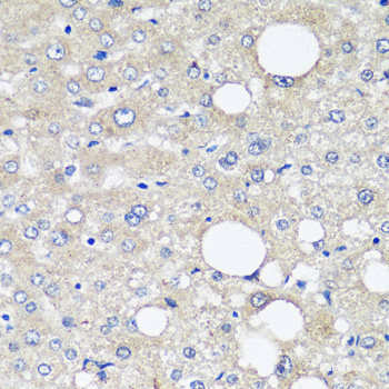 Immunohistochemistry of paraffin-embedded Human liver cancer using AFP Monoclonal Antibody at dilution of 1:12.5 (40x lens).