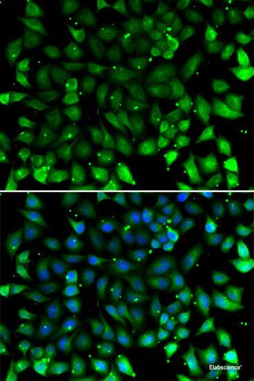 Immunohistochemistry of paraffin-embedded Human kidney cancer using Syndecan-1 Polyclonal Antibody at dilution of 1:200 (40x lens).