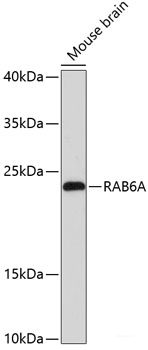 Immunohistochemistry of paraffin-embedded Human liver cancer using CHAT Polyclonal Antibody at dilution of 1:200 (40x lens).