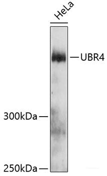 Immunohistochemistry of paraffin-embedded Human colon carcinoma using TIA1 Polyclonal Antibody at dilution of 1:100 (40x lens).