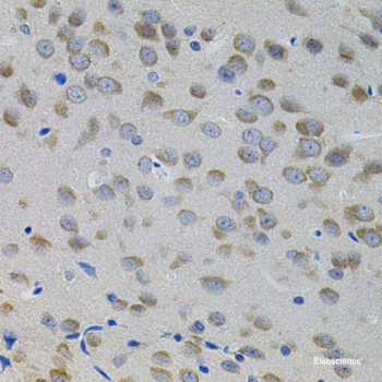 Immunohistochemistry of paraffin-embedded Human liver cancer using RASSF1 Polyclonal Antibody at dilution of 1:100 (40x lens).