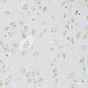 Immunohistochemistry of paraffin-embedded Human lung cancer using CDCA8 Polyclonal Antibody at dilution of 1:100 (40x lens).