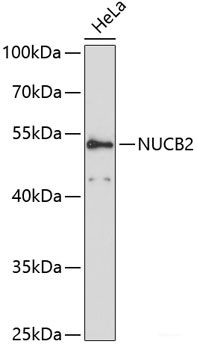 Immunohistochemistry of paraffin-embedded Human liver cancer using FKBP10 Polyclonal Antibody at dilution of 1:150 (40x lens).