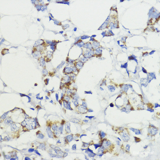 Immunohistochemistry of paraffin-embedded Human mammary cancer using PGK2 Polyclonal Antibody at dilution of 1:100 (40x lens).
