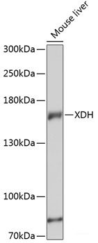 Immunohistochemistry of paraffin-embedded Human liver cancer using AP2A2 Polyclonal Antibody at dilution of 1:200 (40x lens).