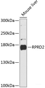 Immunohistochemistry of paraffin-embedded Human gastric cancer using DR1 Polyclonal Antibody at dilution of 1:100 (40x lens).