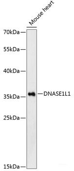 Immunohistochemistry of paraffin-embedded Human liver cancer using FSCN1 Polyclonal Antibody at dilution of 1:100 (40x lens).
