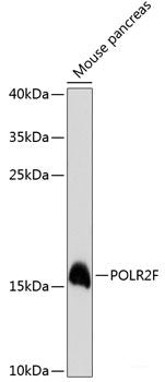 Immunohistochemistry of paraffin-embedded Human prostate cancer using XRCC5 Polyclonal Antibody at dilution of 1:100 (40x lens).