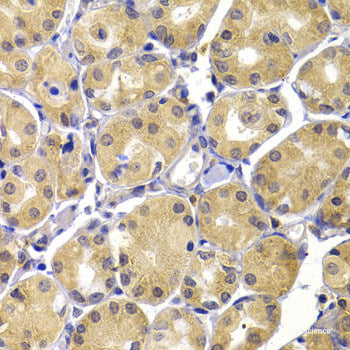 Immunohistochemistry of paraffin-embedded Human mammary cancer using VTN Polyclonal Antibody at dilution of 1:100 (40x lens).