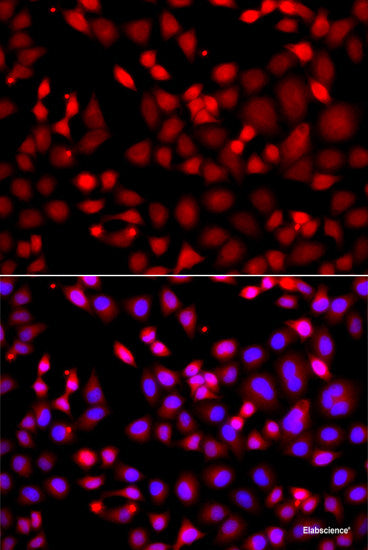 Immunohistochemistry of paraffin-embedded Human liver cancer using RPH3A Polyclonal Antibody at dilution of 1:100 (40x lens).