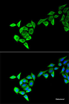 Immunohistochemistry of paraffin-embedded Human lung cancer using PAX3 Polyclonal Antibody at dilution of 1:100 (40x lens).