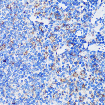 Immunohistochemistry of paraffin-embedded Human gastric cancer using GCLM Polyclonal Antibody at dilution of 1:100 (40x lens).