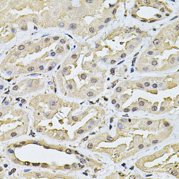 Immunohistochemistry of paraffin-embedded Human thyroid cancer using RPL24 Polyclonal Antibody at dilution of 1:100 (40x lens).