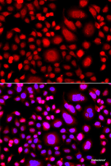 Immunohistochemistry of paraffin-embedded Human lung cancer using ASCL4 Polyclonal Antibody at dilution of 1:100 (40x lens).